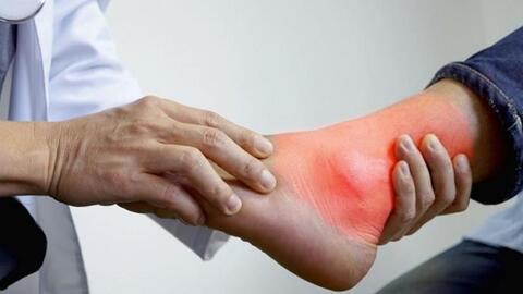 Nguy hiểm của biến chứng gout không điều trị