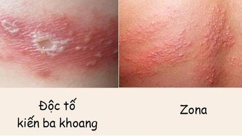 Phân biệt vết đốt của kiến ba khoang và zona thần kinh