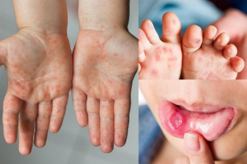 Bệnh tay chân miệng leo thang, Bộ Y tế yêu cầu khẩn, ngăn chặn dịch lây lan trên diện rộng