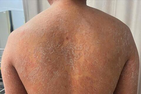 Nấm da lan khắp cơ thể vì tự mua thuốc bôi