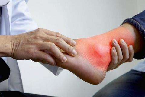 Nguy hiểm của biến chứng gout không điều trị