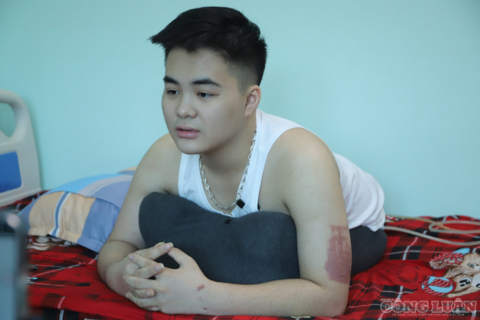 Bác sĩ 30 năm trong nghề kể về ca bệnh 'chưa từng có': Cậu thanh niên 17 tuổi mất gần toàn bộ phần thân dưới vẫn giành lại sự sống