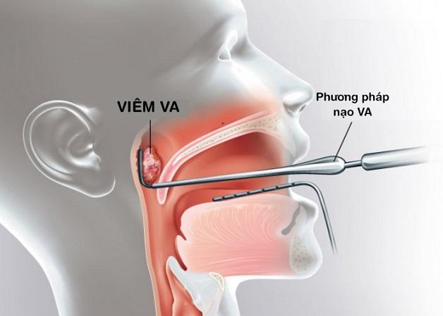 Viêm VA ở trẻ: Cẩn trọng để tránh biến chứng ngưng thở khi ngủ - Ảnh 2.